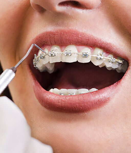 dental-braces-or-clips