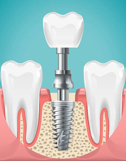 dental-implants