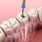 microscopic-root-canal-treatment