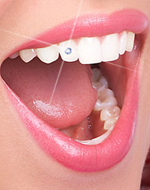 tooth-jewellery